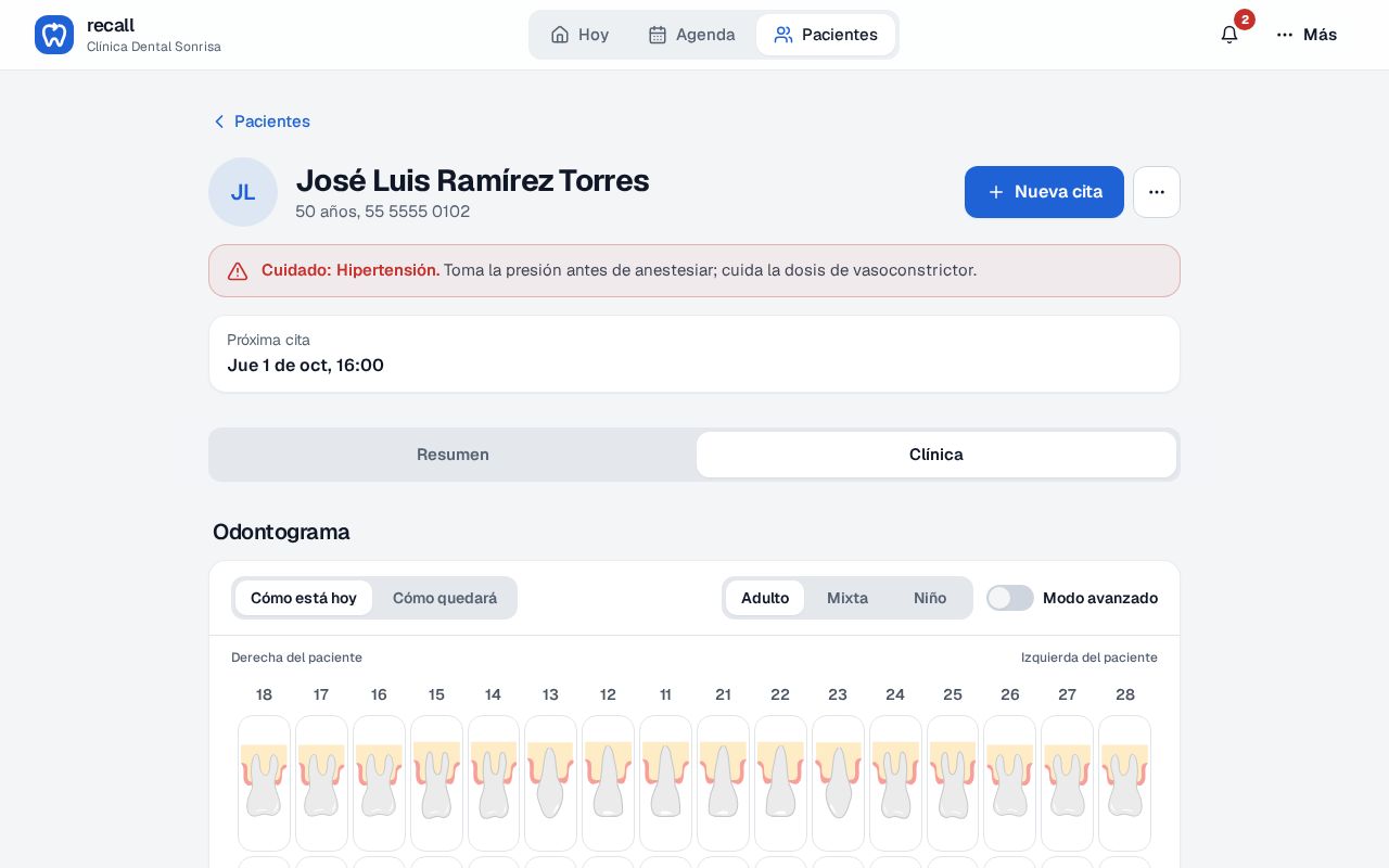Ficha de José Luis Ramírez Torres en Recall vista por la asistente: alerta de hipertensión, pestañas Resumen y Clínica, sin Pagos ni saldo